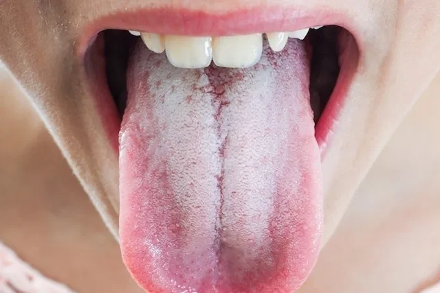 10 Tips Merawat Lidah Saat Terkena Infeksi Virus